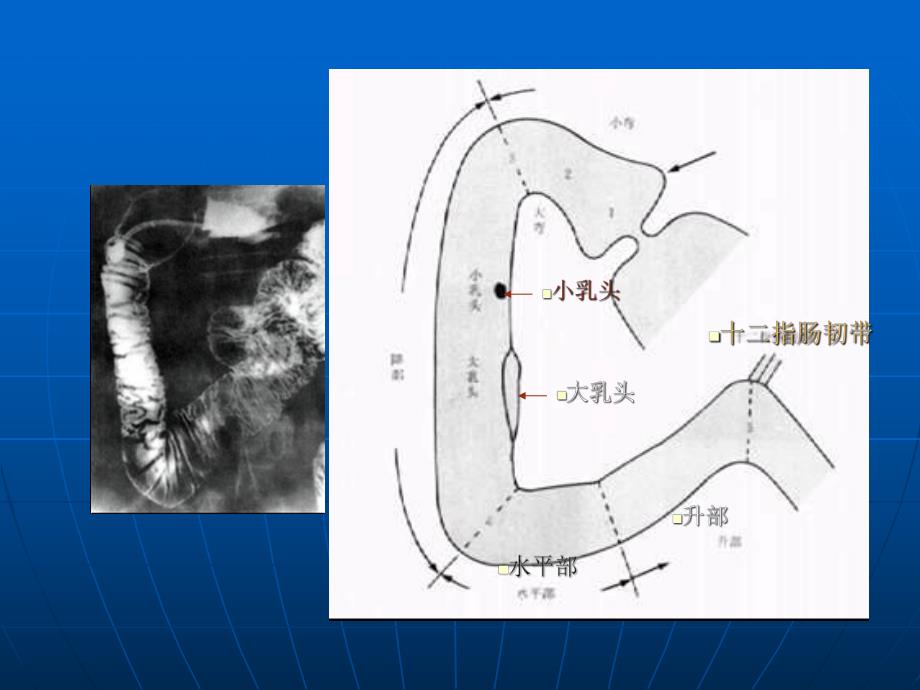 十二指肠疾病.ppt_第3页