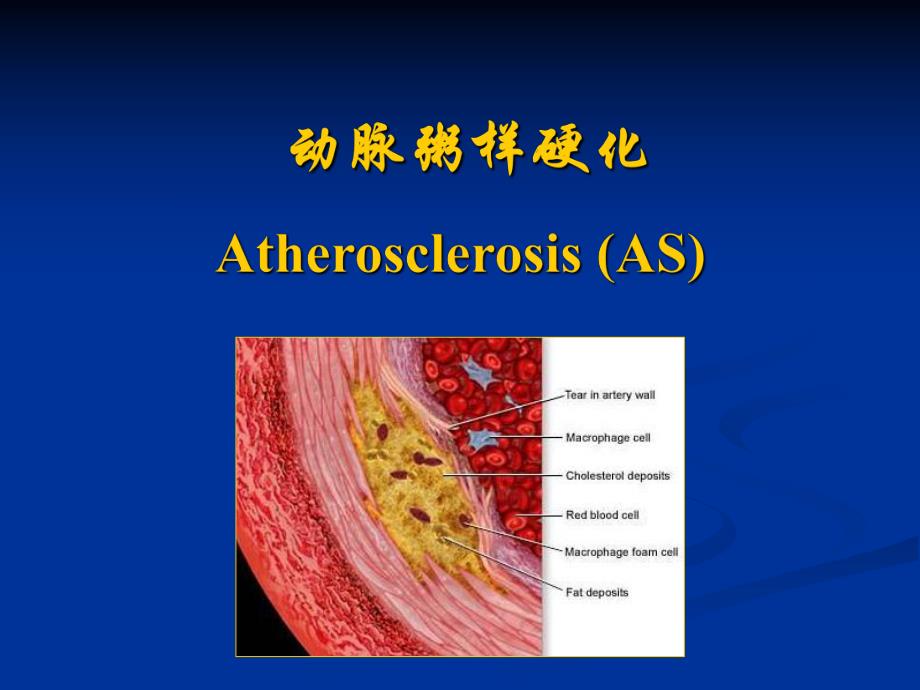 动脉粥样硬化.ppt_第2页