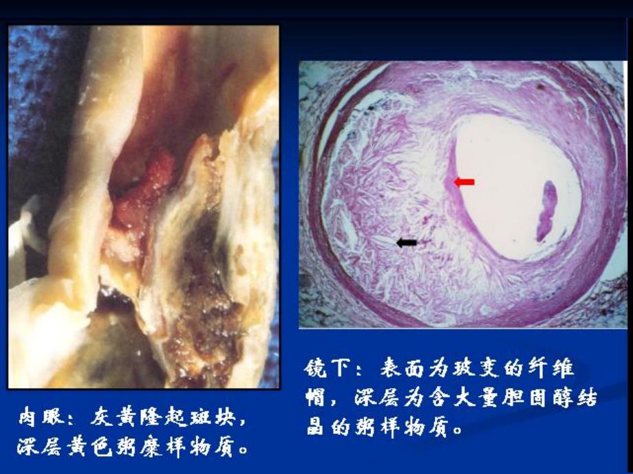 动脉粥样硬化.ppt_第3页