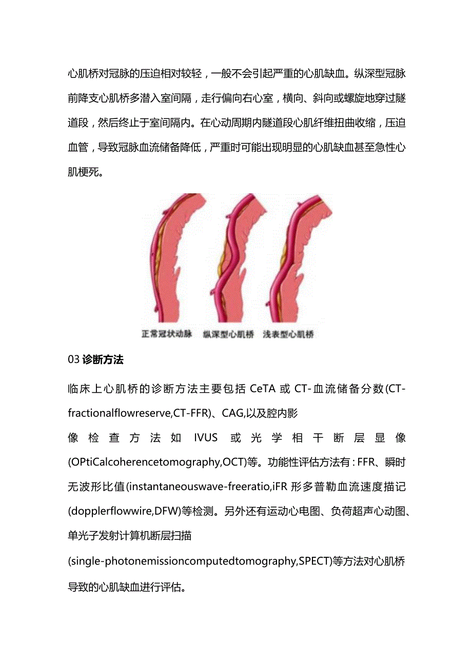 2024心肌桥的诊断与治疗.docx_第2页