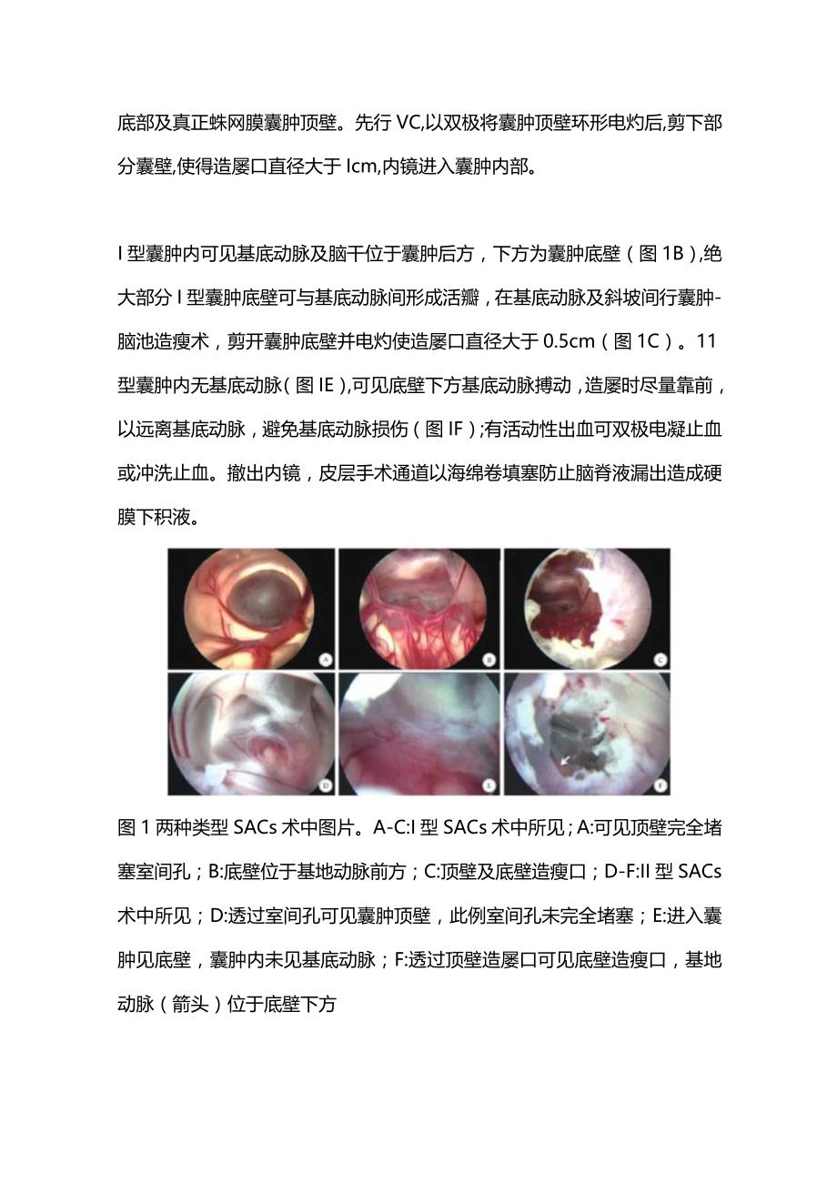 儿童鞍上蛛网膜囊肿的内镜治疗及疗效评估2024.docx_第3页