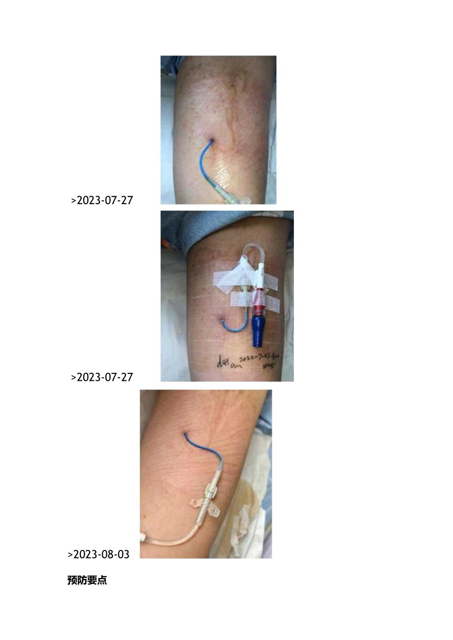 PICC置管相关皮肤损伤的预防2024.docx_第3页