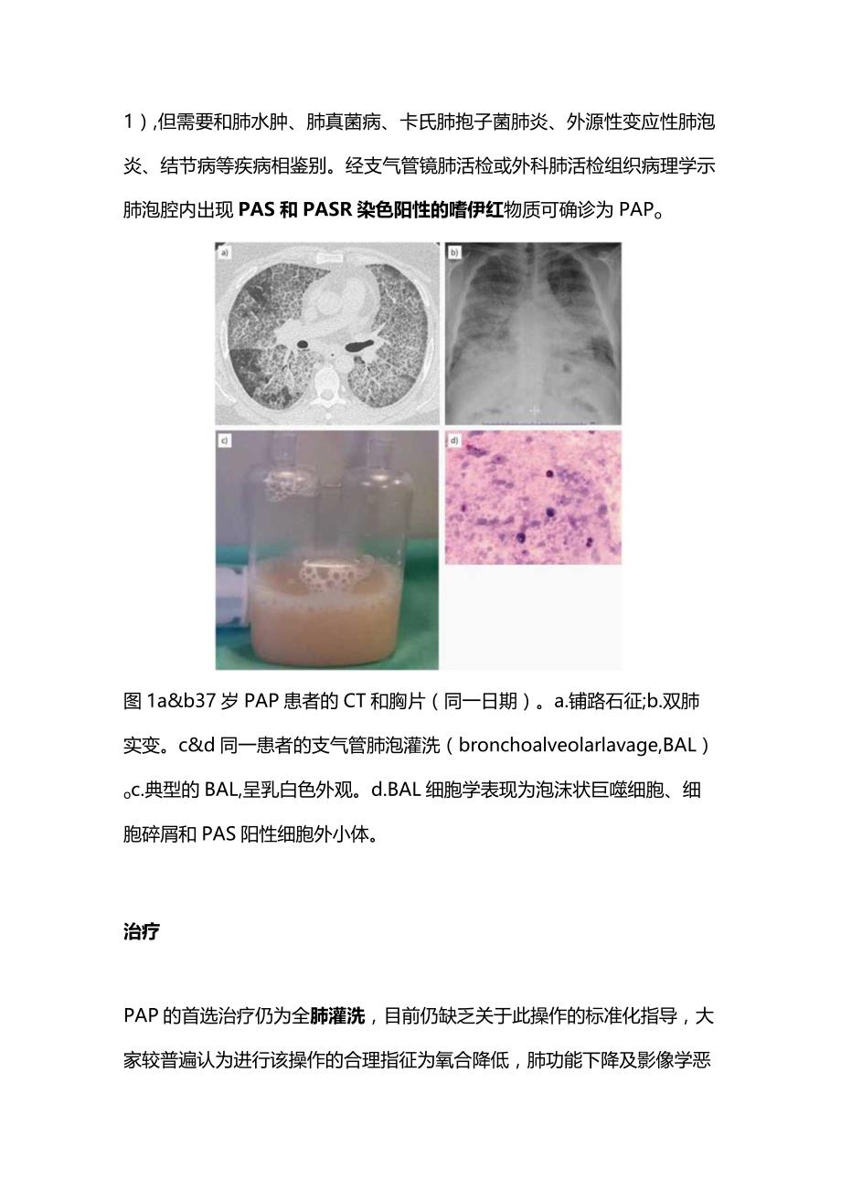 少见间质性肺疾病2024.docx_第3页