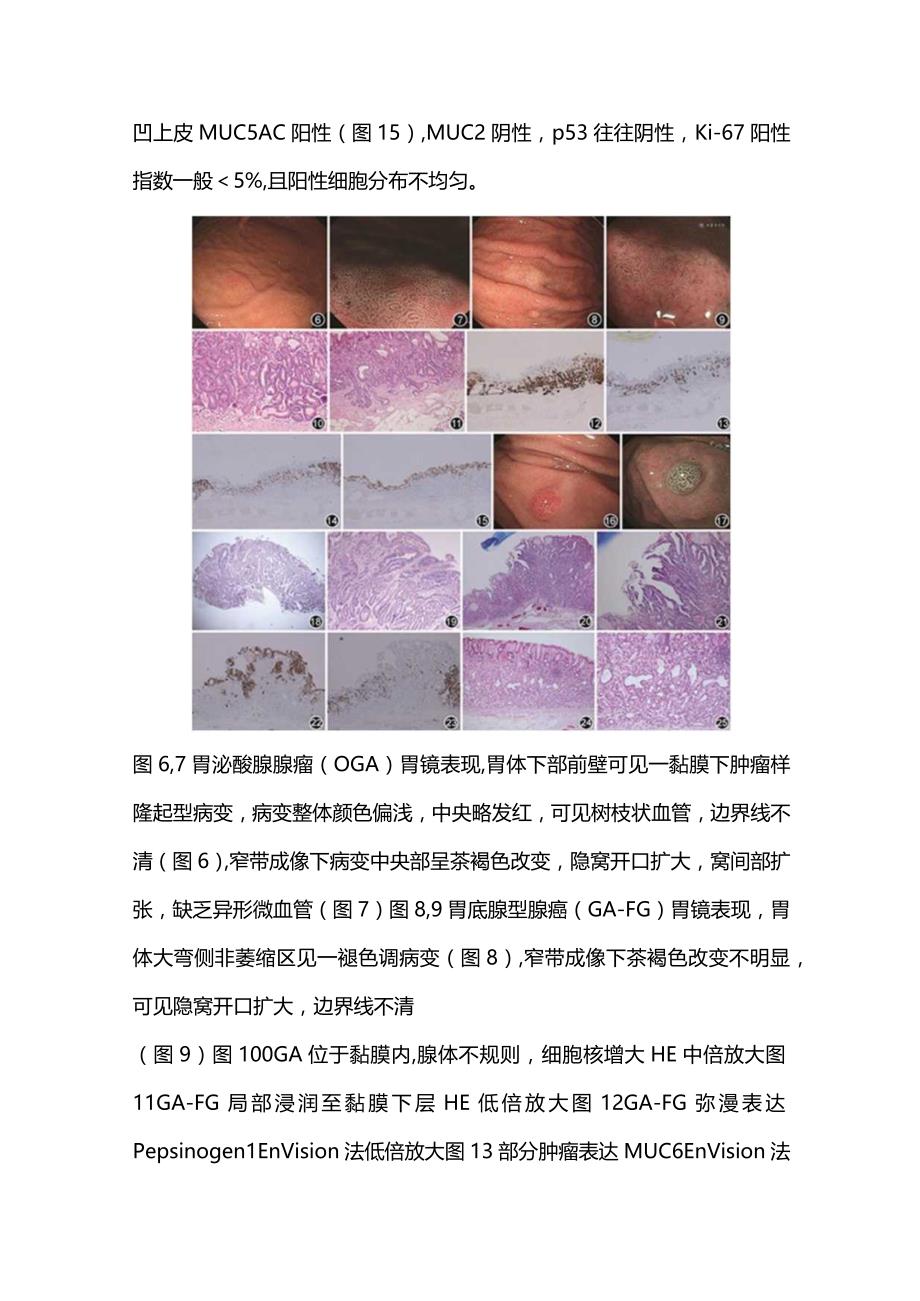 2024胃底腺型肿瘤临床及病理学特点.docx_第3页