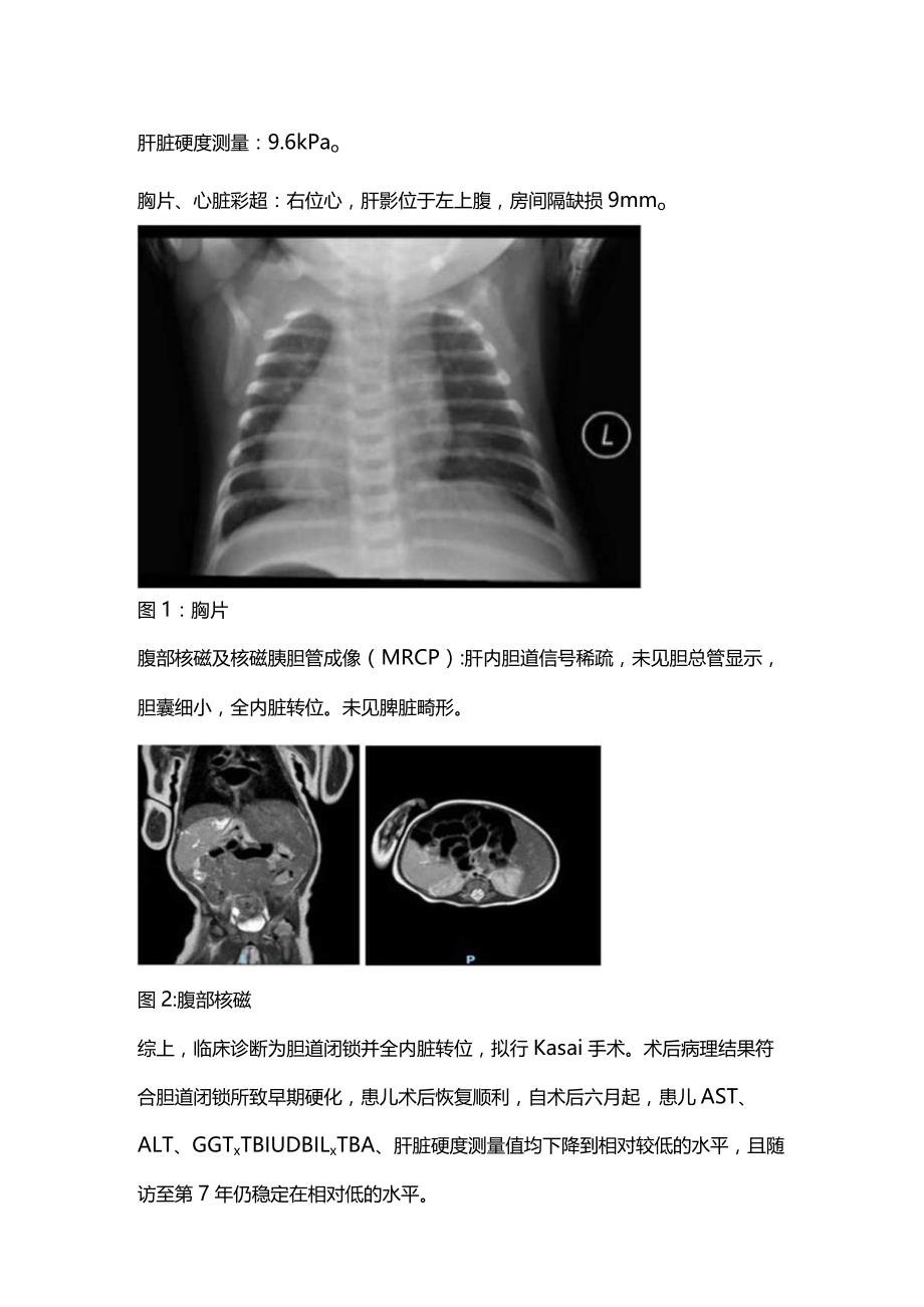 2024婴儿胆道闭锁诊治专家总结要点.docx_第2页