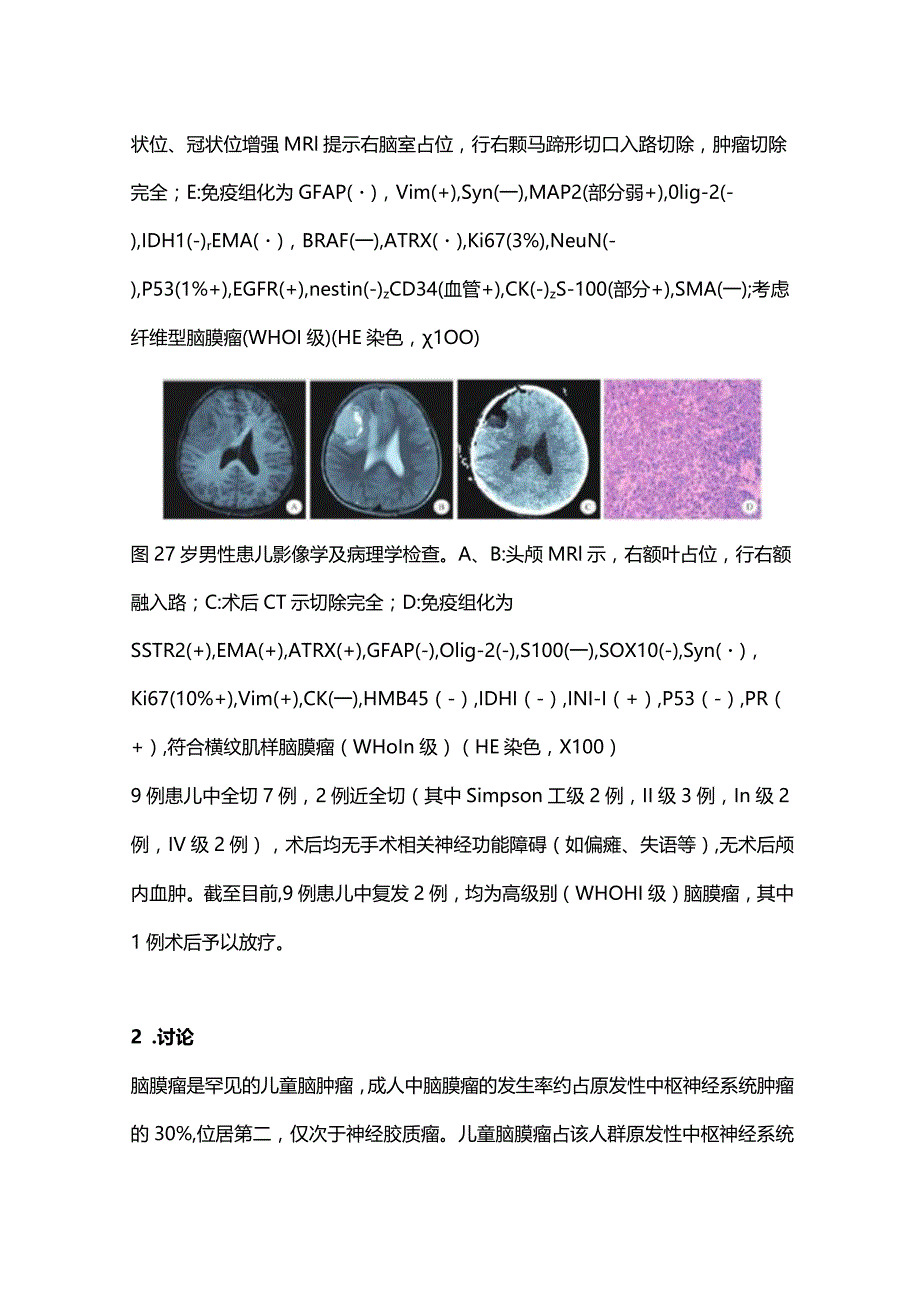 儿童脑膜瘤的临床特征与治疗2024.docx_第3页