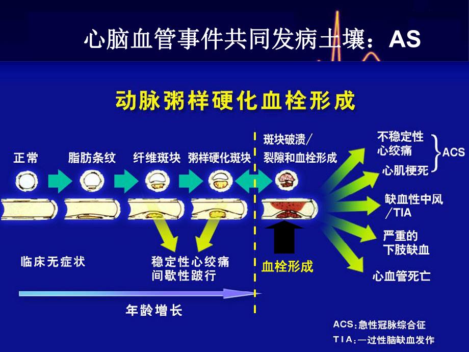 合并脑卒中的急性冠脉综合征患者抗栓治疗.ppt_第3页