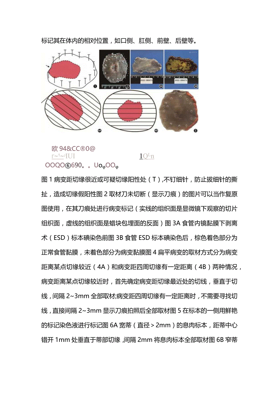 内镜黏膜下剥离术内镜黏膜切除术标本常规制片专家共识2023.docx_第3页