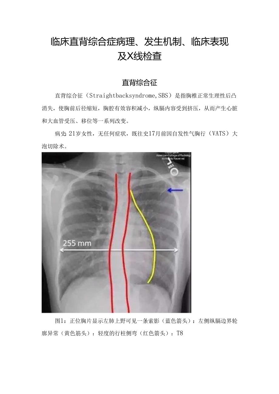 临床直背综合症病理、发生机制、临床表现及X线检查.docx_第1页