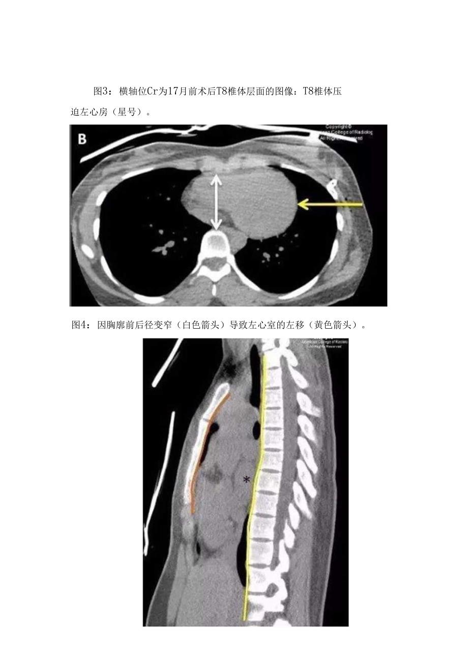 临床直背综合症病理、发生机制、临床表现及X线检查.docx_第3页