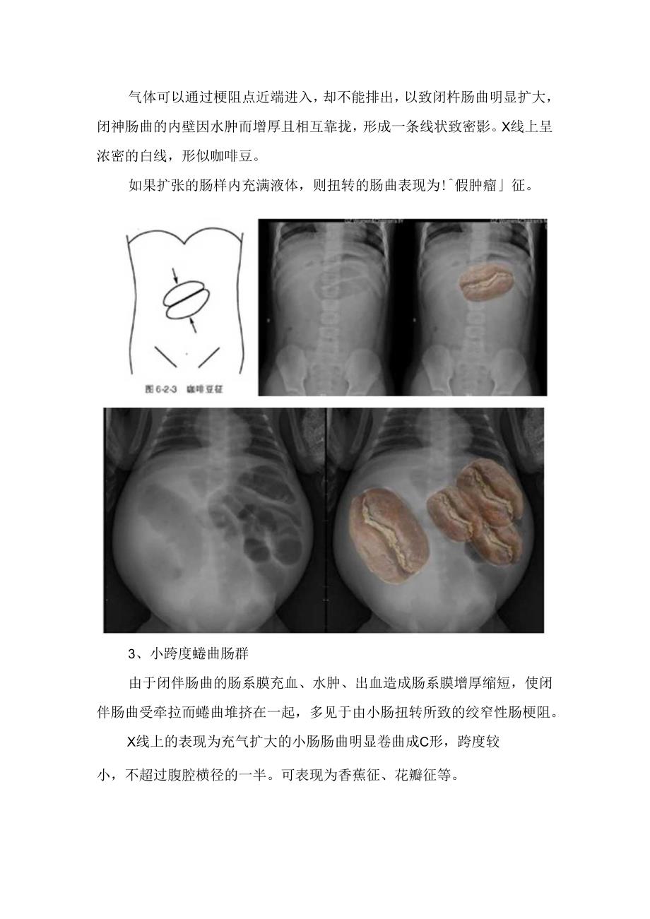 临床小肠梗阻表现、绞窄性肠梗阻特征性征象及生理表现.docx_第3页