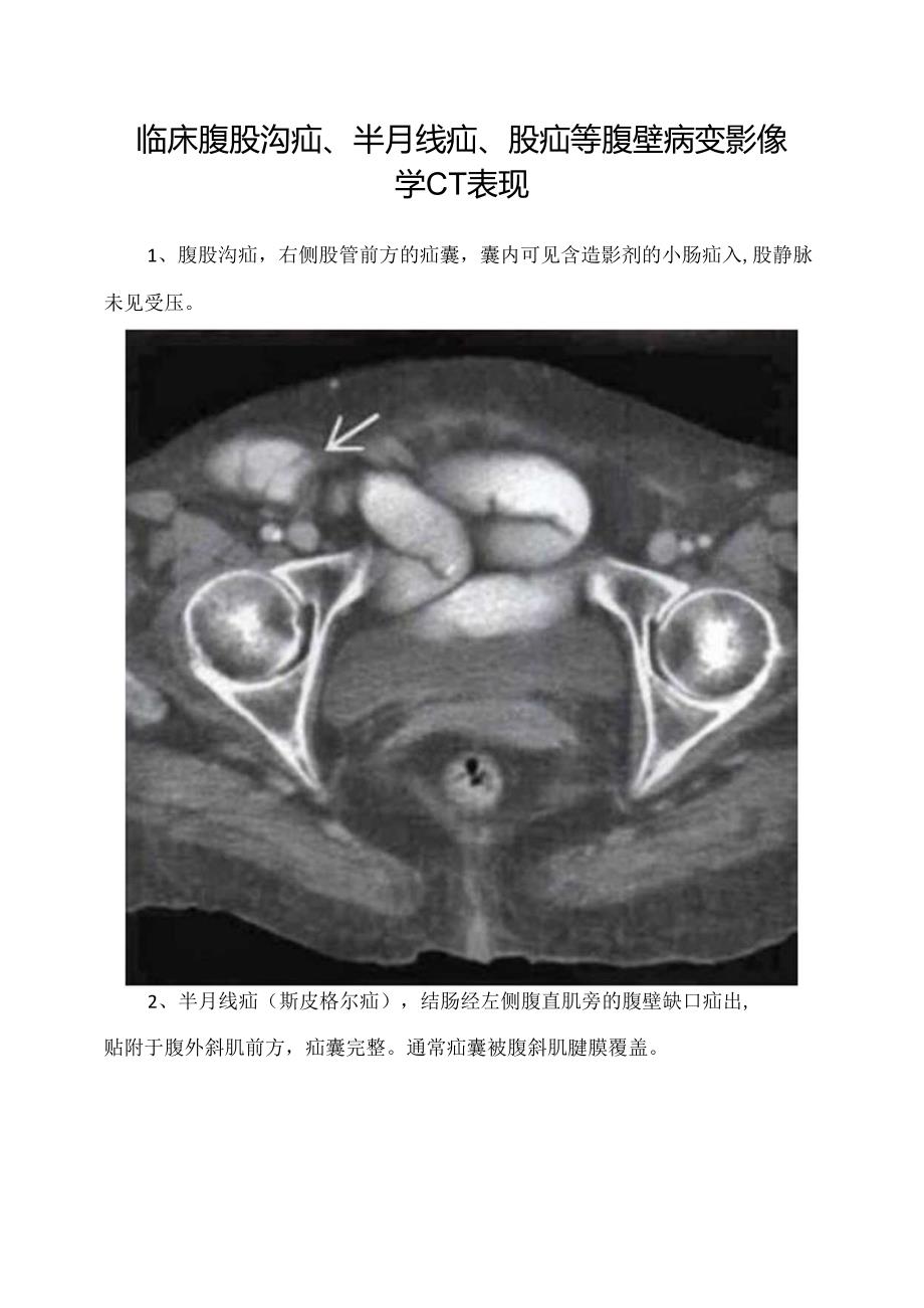 临床腹股沟疝、半月线疝、股疝等腹壁病变影像学CT表现.docx_第1页