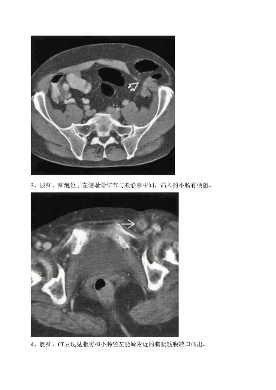 临床腹股沟疝、半月线疝、股疝等腹壁病变影像学CT表现.docx_第2页