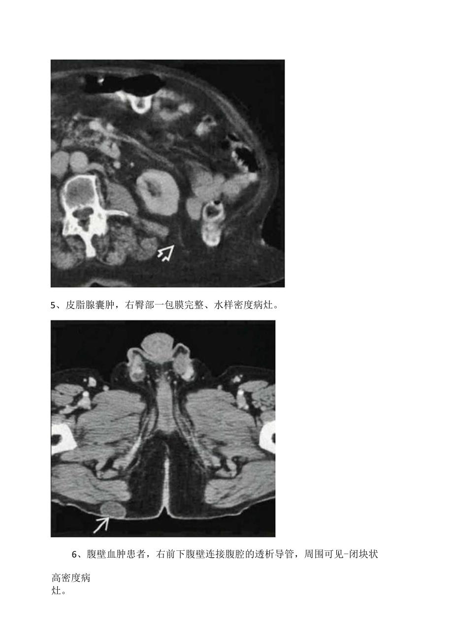 临床腹股沟疝、半月线疝、股疝等腹壁病变影像学CT表现.docx_第3页