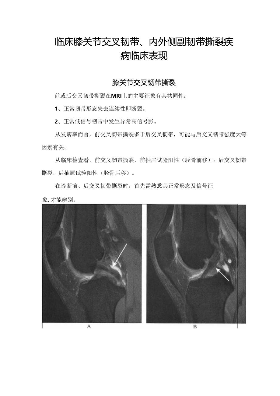 临床膝关节交叉韧带、内外侧副韧带撕裂疾病临床表现.docx_第1页