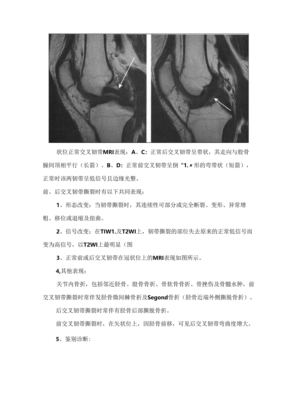 临床膝关节交叉韧带、内外侧副韧带撕裂疾病临床表现.docx_第2页