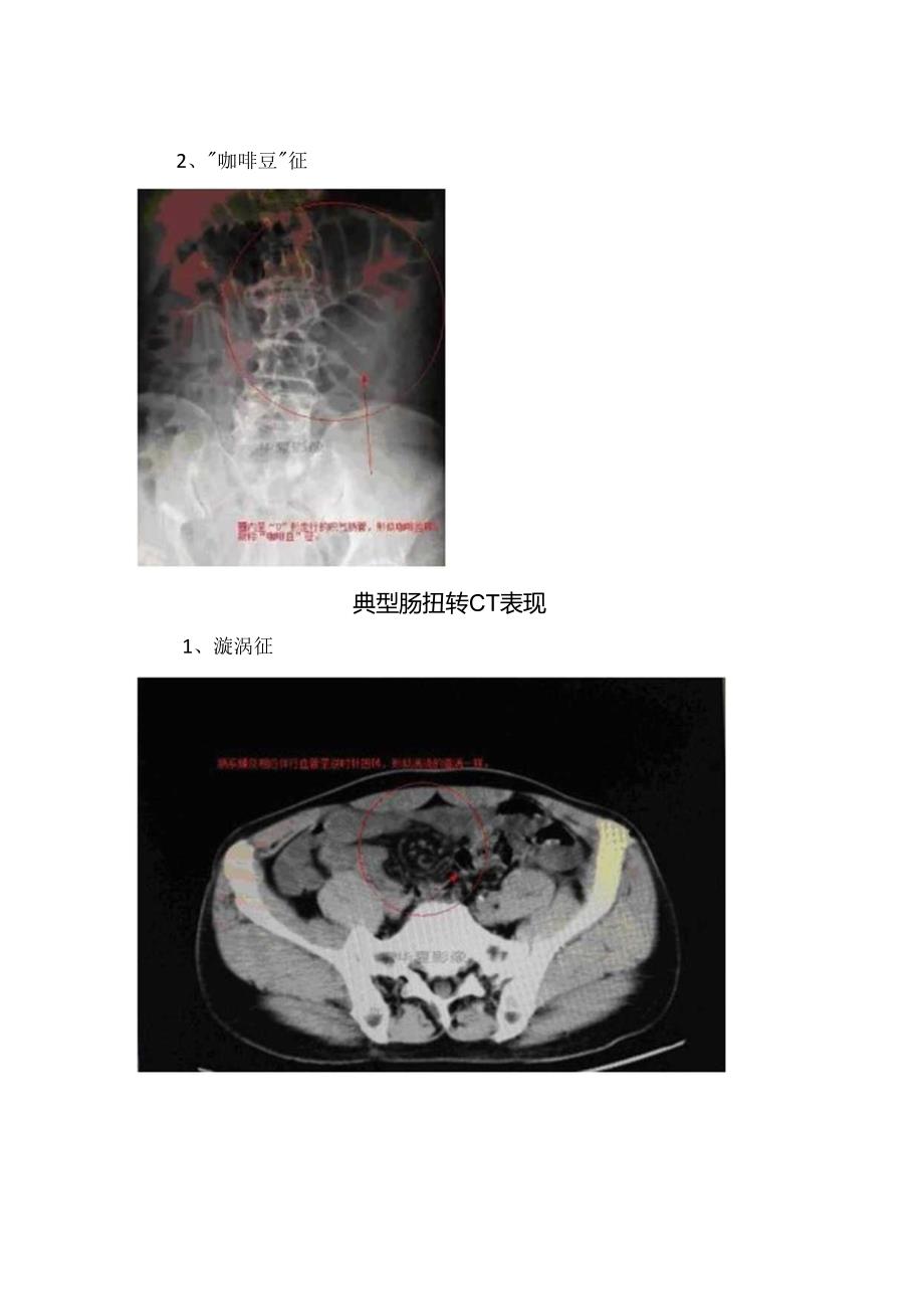 临床肠扭转影像表现、典型腹部平片及肠扭转CT表现.docx_第3页