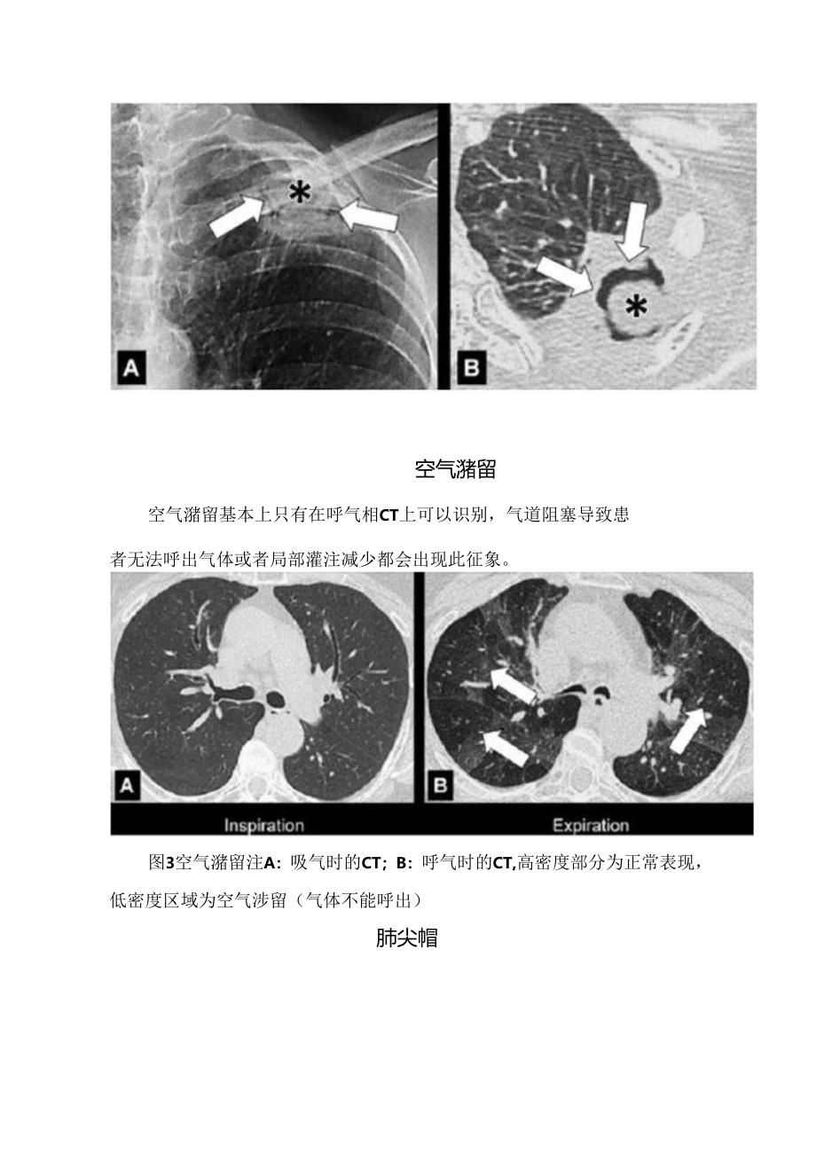 临床空气支气管征、 空气新月征、肺尖帽树芽征、铺路石征等胸部影像要点.docx_第2页