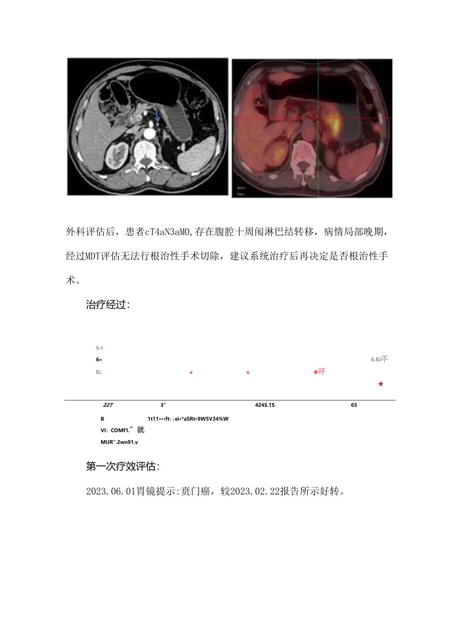 后腹膜淋巴结转移胃癌患者转化治疗.docx_第2页