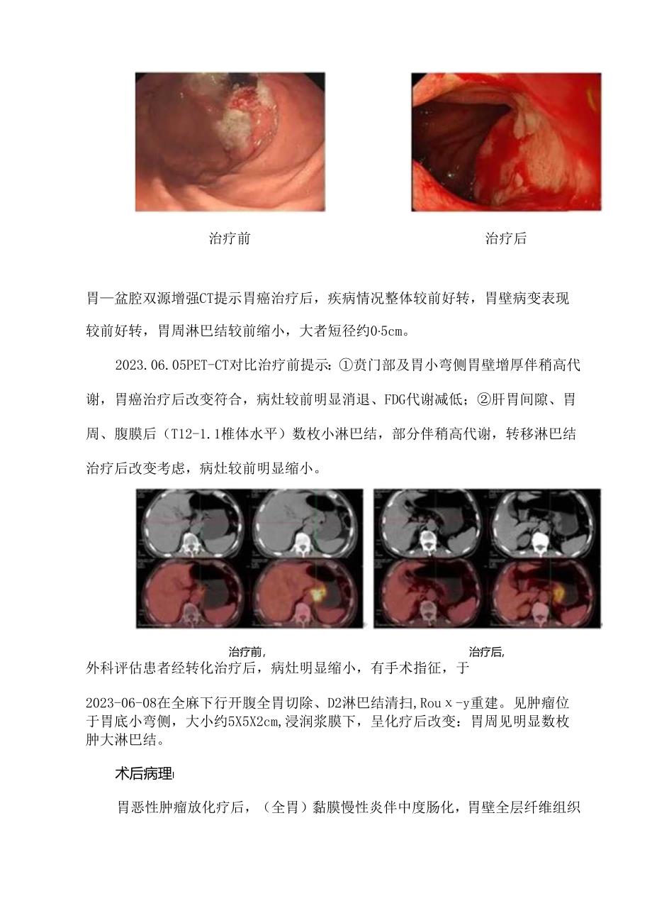 后腹膜淋巴结转移胃癌患者转化治疗.docx_第3页