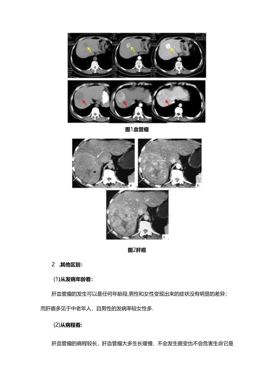 肝血管瘤和肝癌的鉴别.docx_第3页