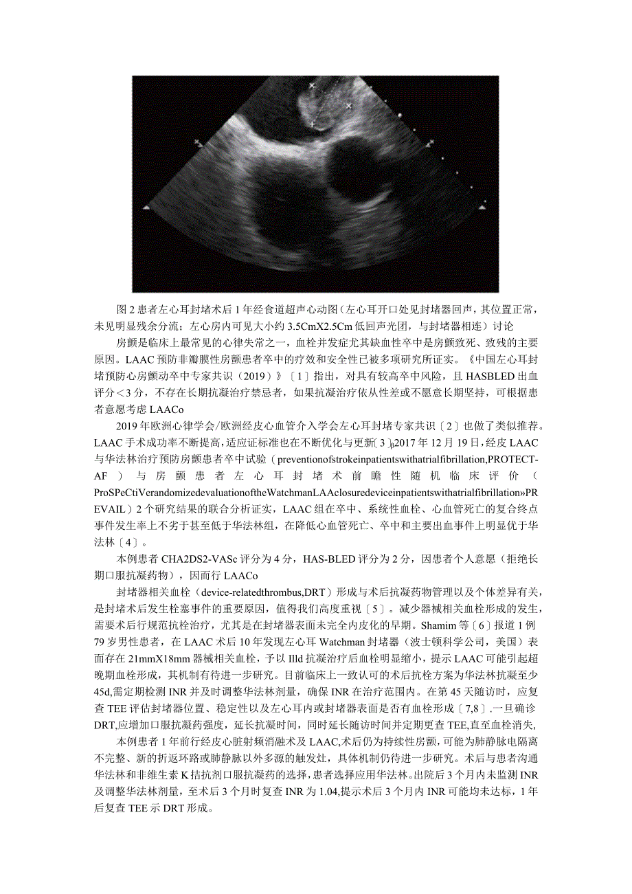 （病例报告）左心耳封堵器血栓两例.docx_第2页