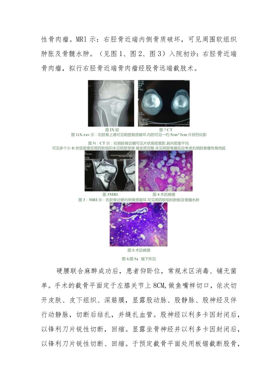 外科右胫骨近端骨肉瘤病例分析专题报告.docx_第2页