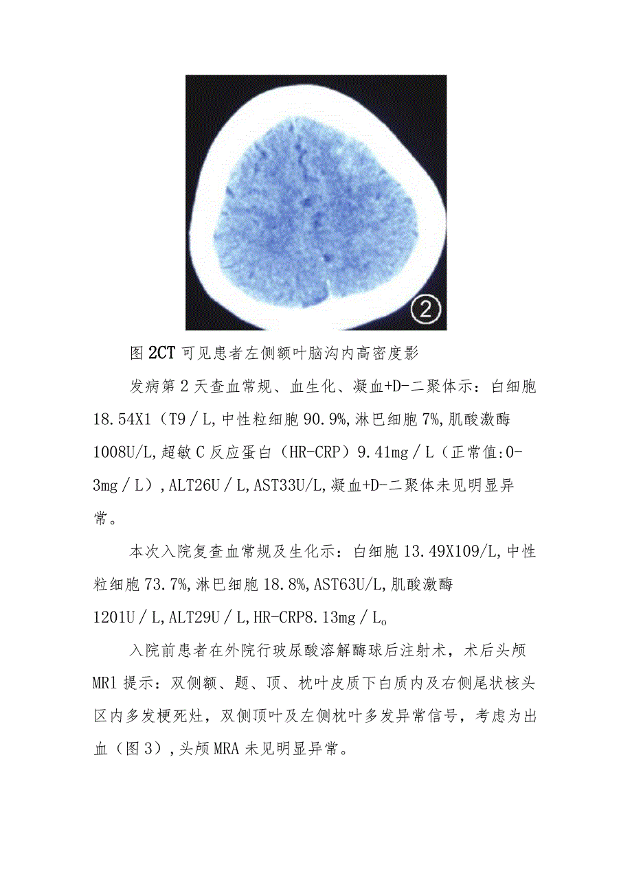 神经内科因隆鼻引起脑梗死和左眼失明病例分析专题报告.docx_第2页