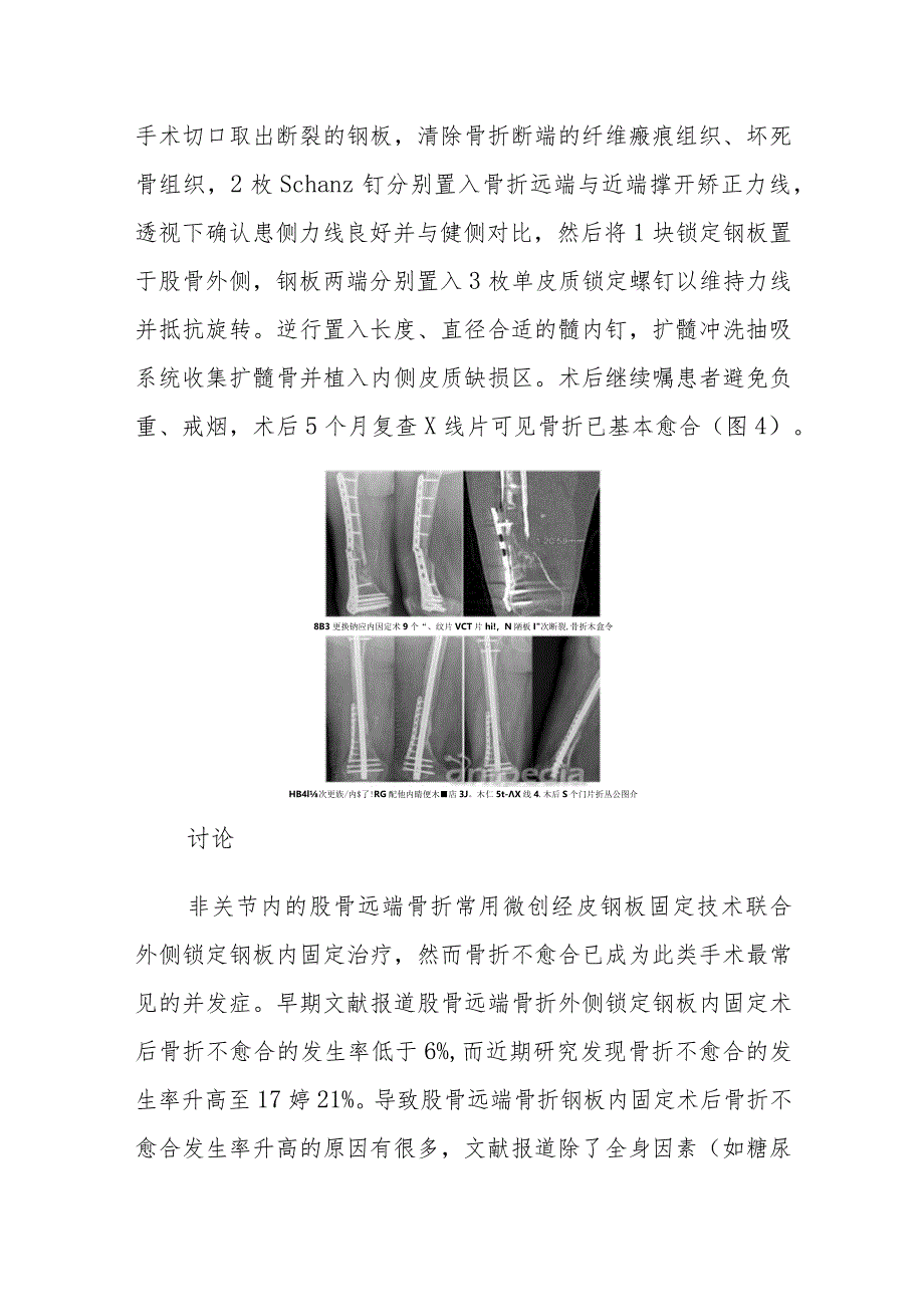 骨科股骨远端骨折内固定术后顽固性骨折不愈合病例分析.docx_第3页