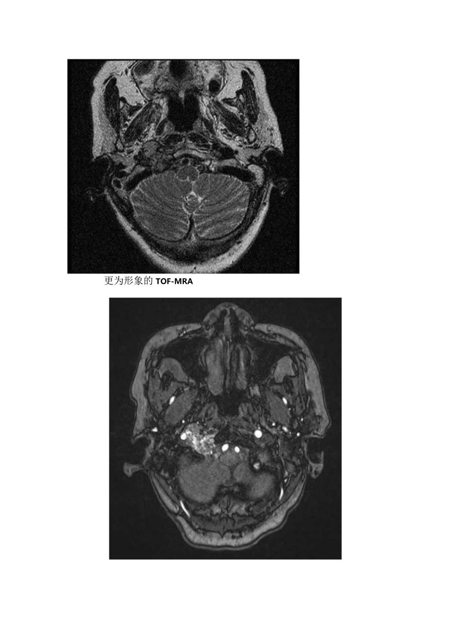 胡椒盐征影像表现、临床病理及鉴别诊断.docx_第3页