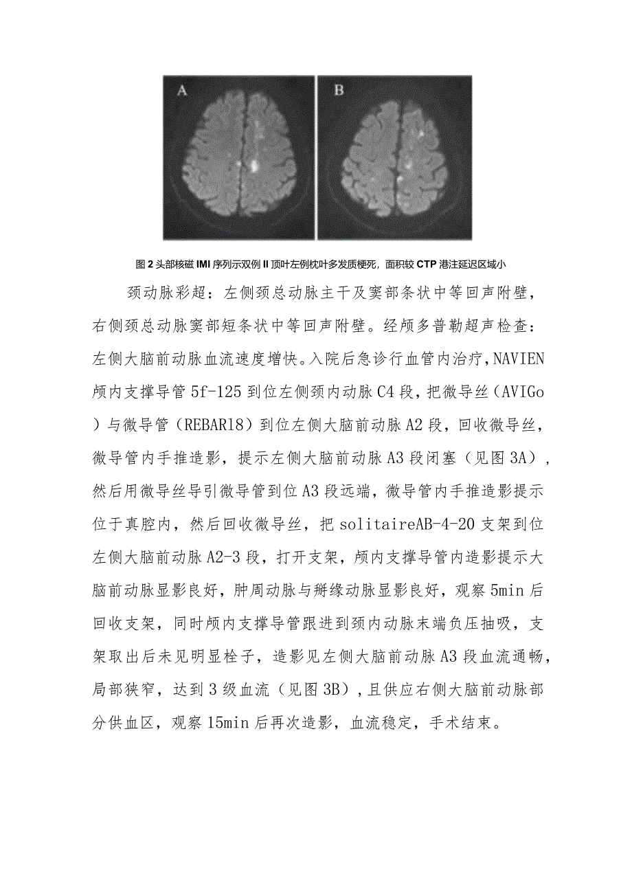 医学影像科CT灌注成像早期诊断双侧大脑前动脉供血区脑梗死病例分析专题报告.docx_第3页