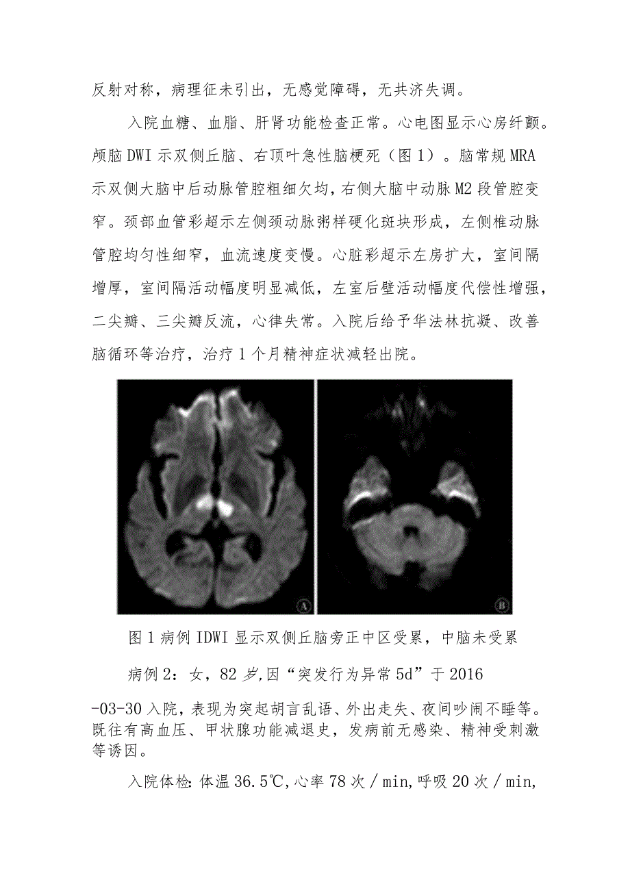 神经内科以精神异常起病的双侧丘脑梗死病例报告专题报告.docx_第2页