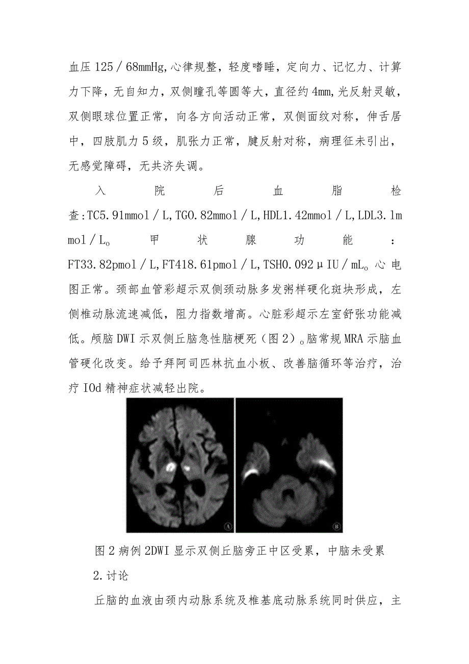 神经内科以精神异常起病的双侧丘脑梗死病例报告专题报告.docx_第3页