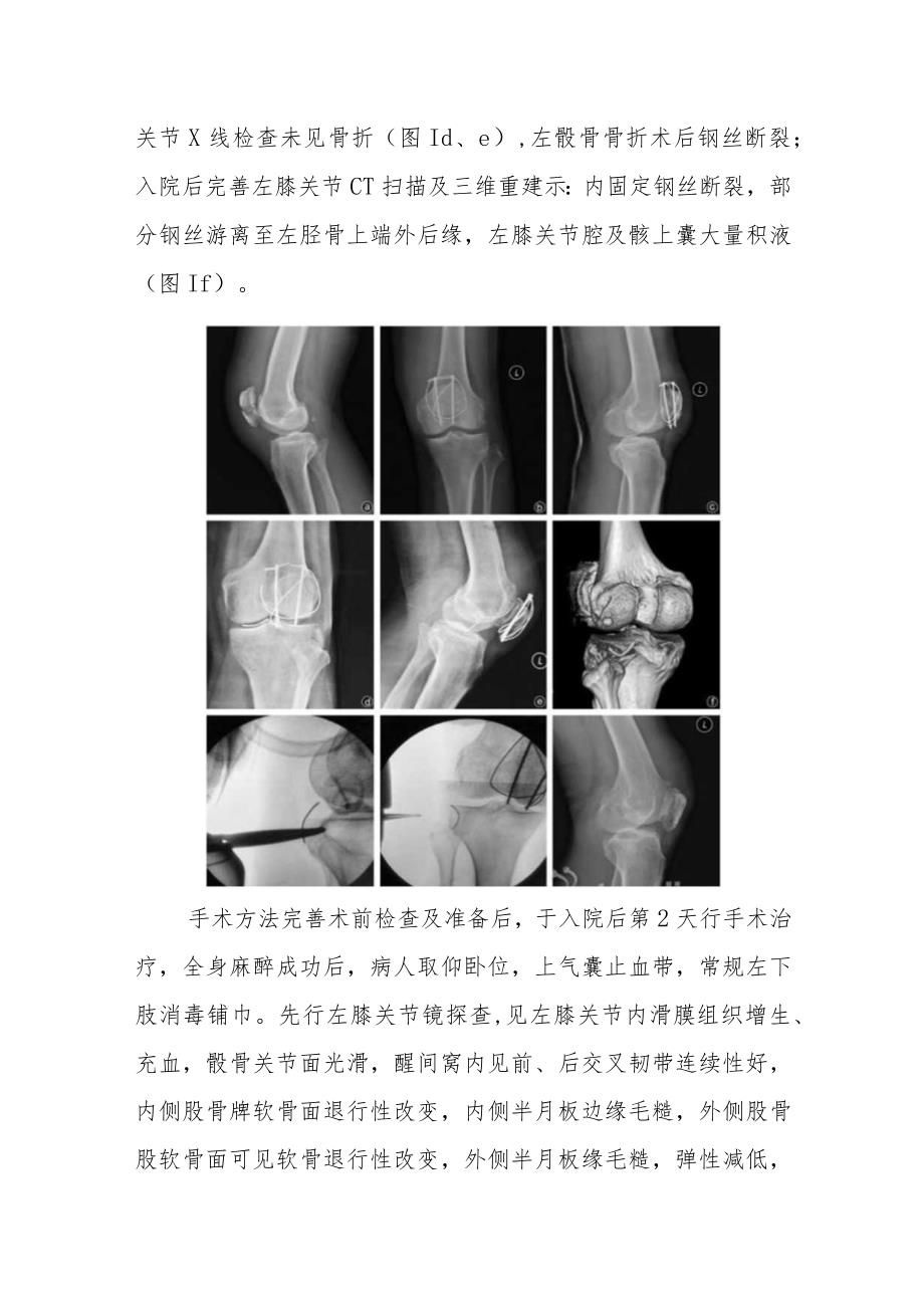 骨科髌骨骨折术后钢丝断裂进入腘窝病例分析专题报告.docx_第2页