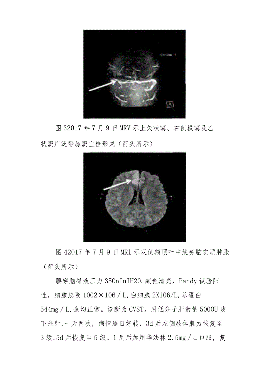 神经内科疑似为急性脑梗死的颅内静脉窦血栓形成病例分析专题报告.docx_第3页