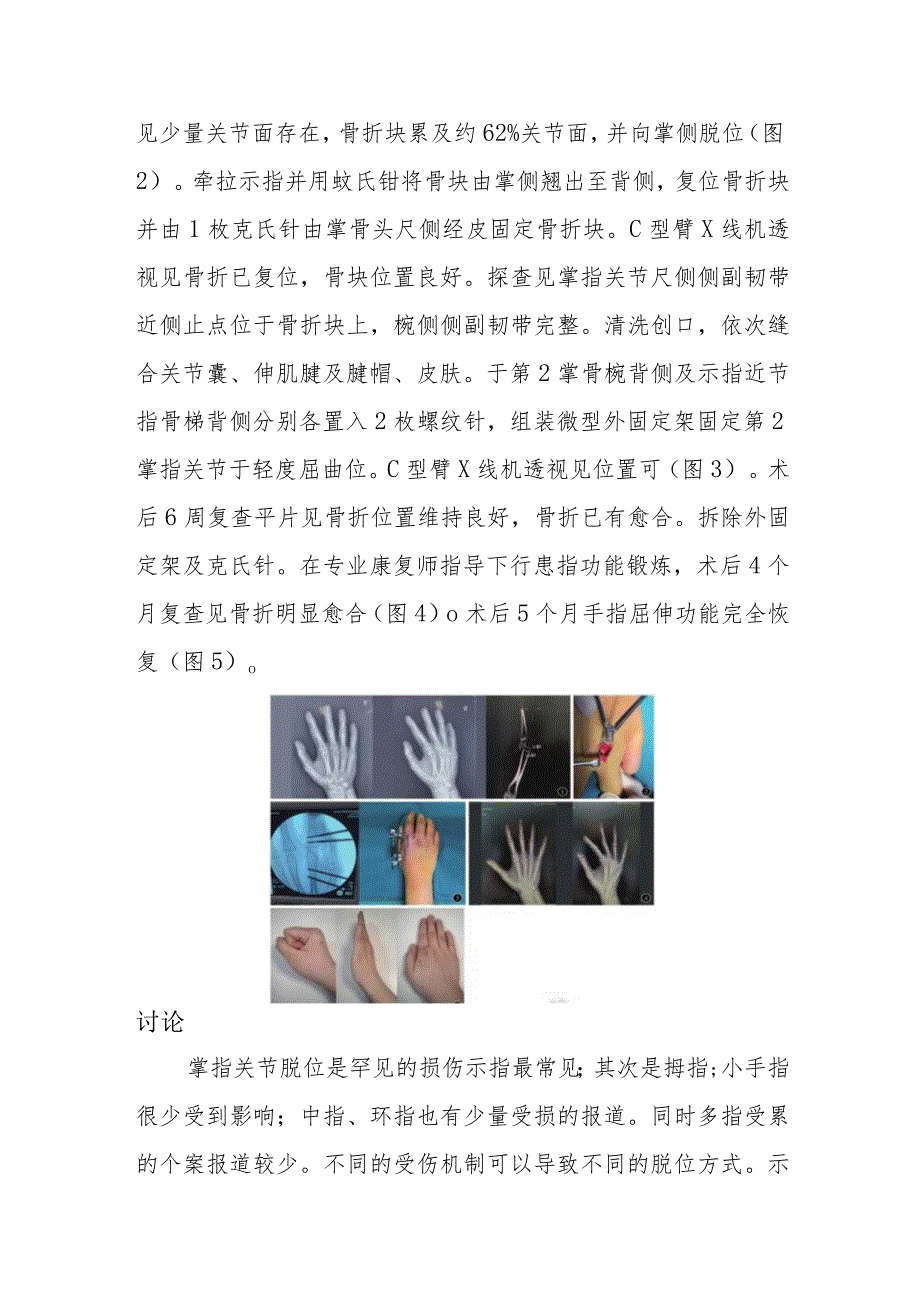 骨科示指掌侧掌指关节脱位合并掌骨头骨折病例分析专题报告.docx_第2页