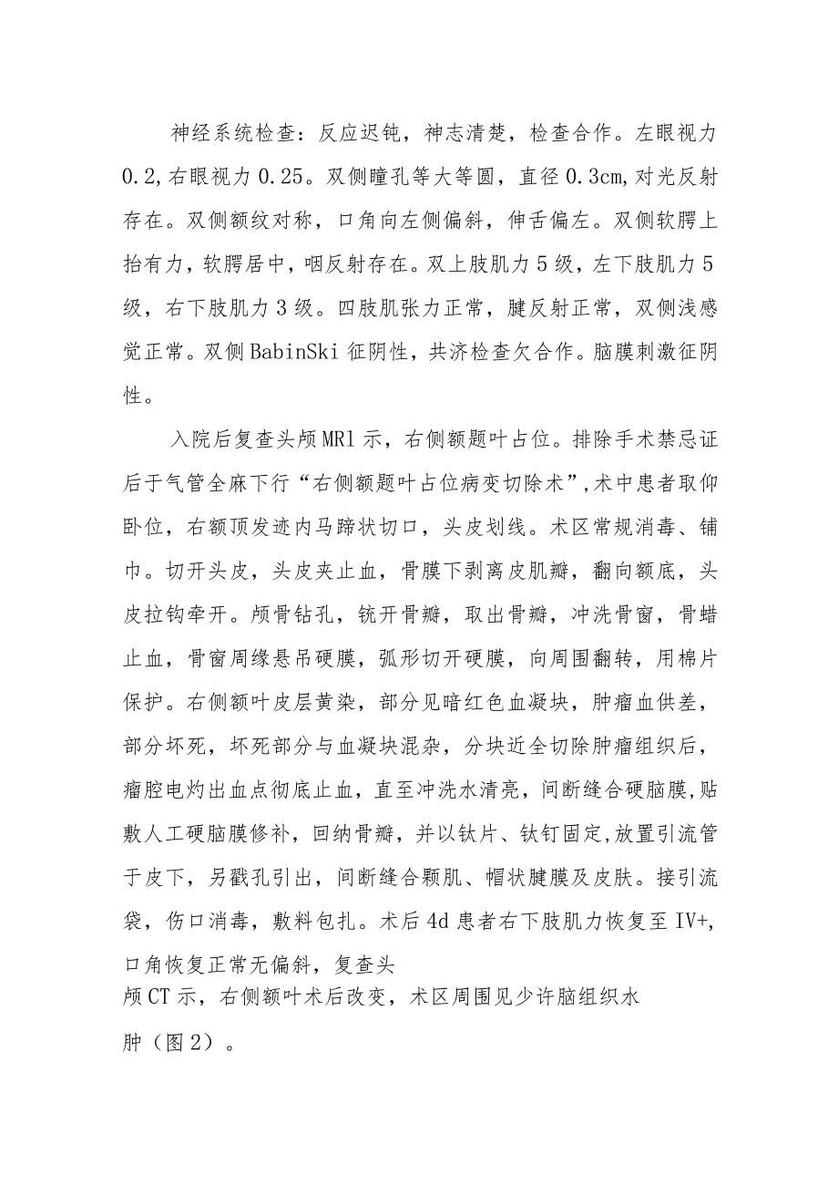 神经内科似脑胶质细胞瘤的脑梗死病例报告专题报告.docx_第2页