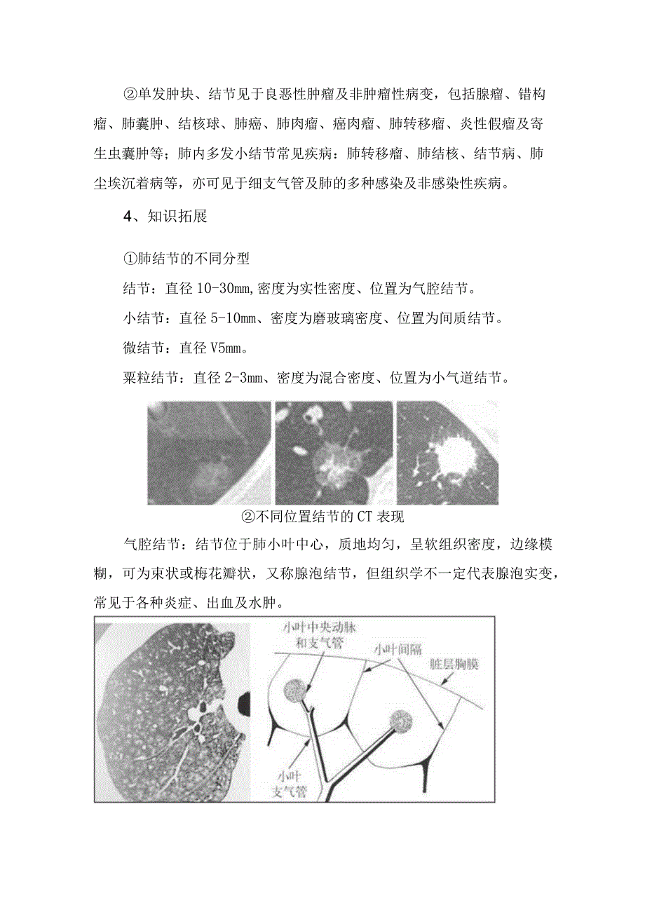 肺内结节肿块与结节临床概述、CT影像表现、重点提醒及临床表现.docx_第3页