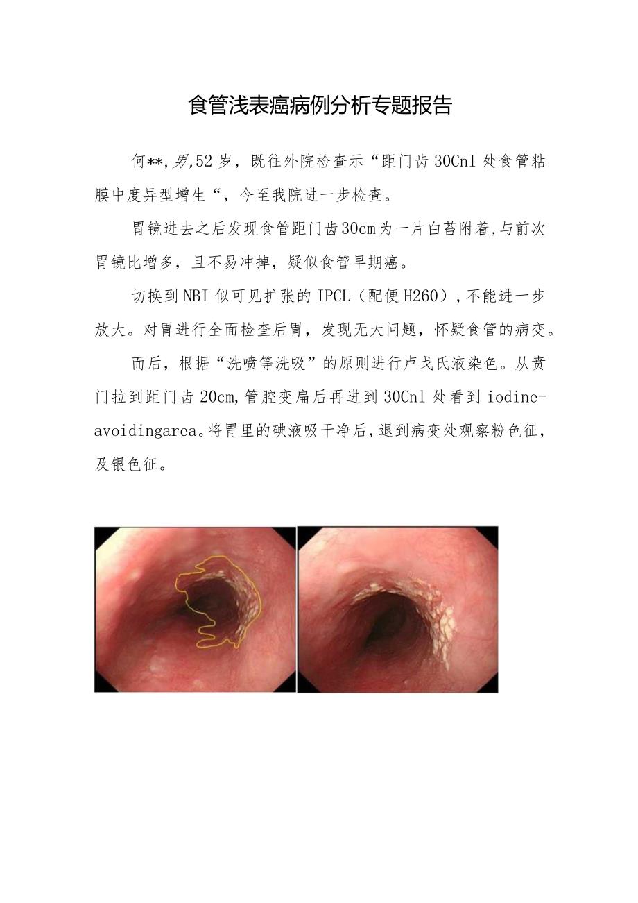 胸外科医师晋升副主任医师病例分析专题报告（食管浅表癌病）.docx_第2页