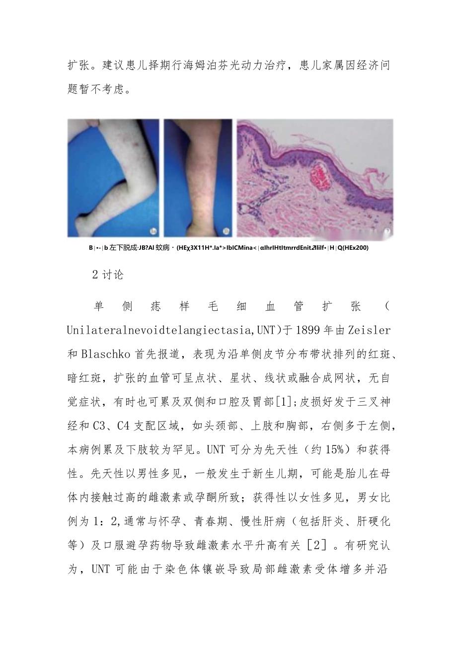 皮肤科先天性单侧痣样毛细血管扩张症病例分析专题报告.docx_第2页