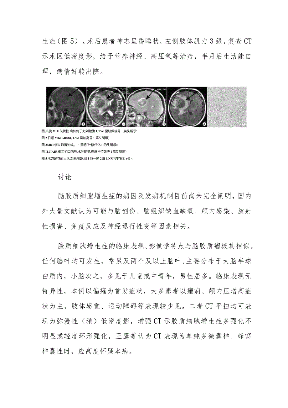 神经外科脑胶质细胞增生症误诊为胶质瘤病例分析专题报告.docx_第2页