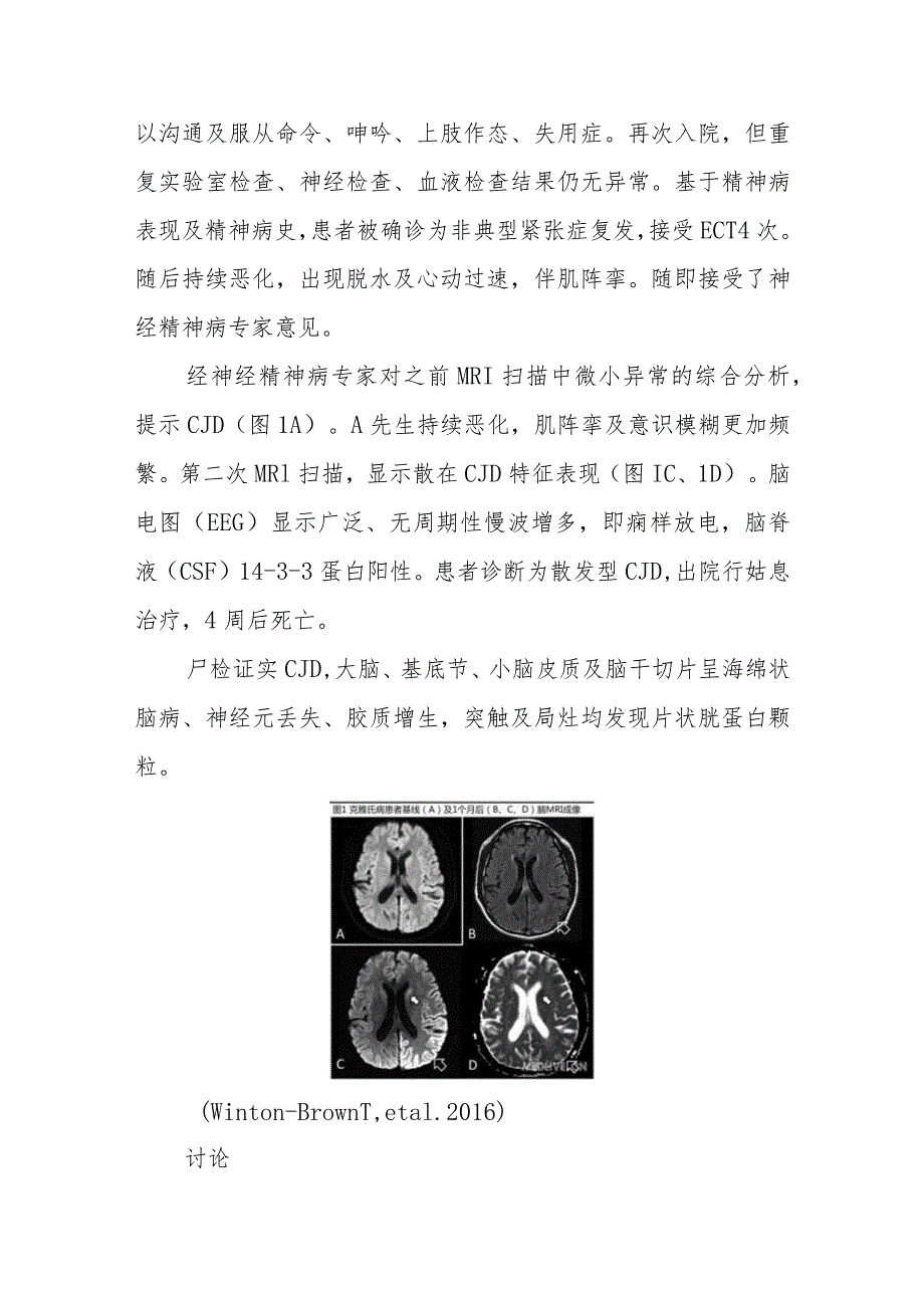 神经内科以紧张症为表现的克雅氏病病例分析专题报告.docx_第2页