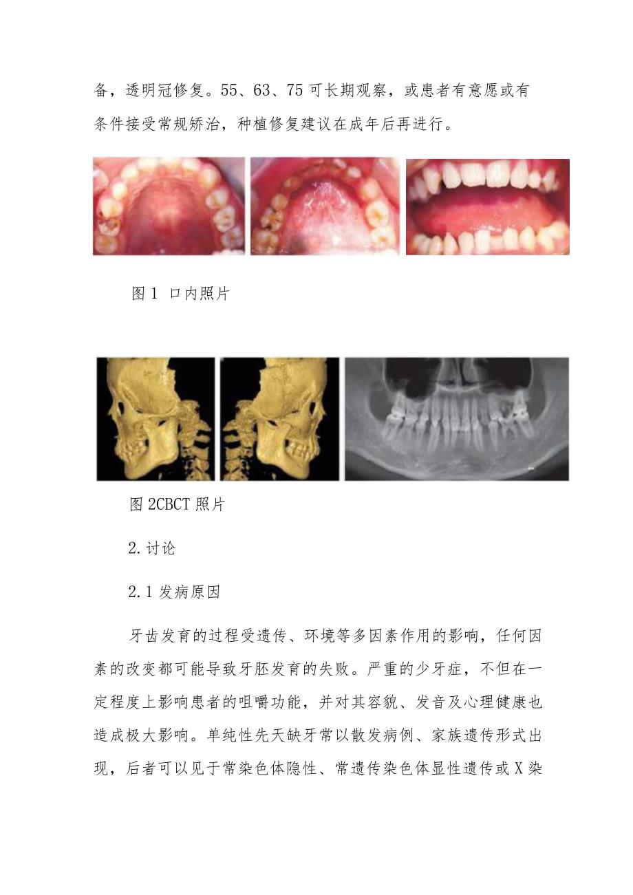 口腔科严重的少牙症病例分析专题报告.docx_第3页