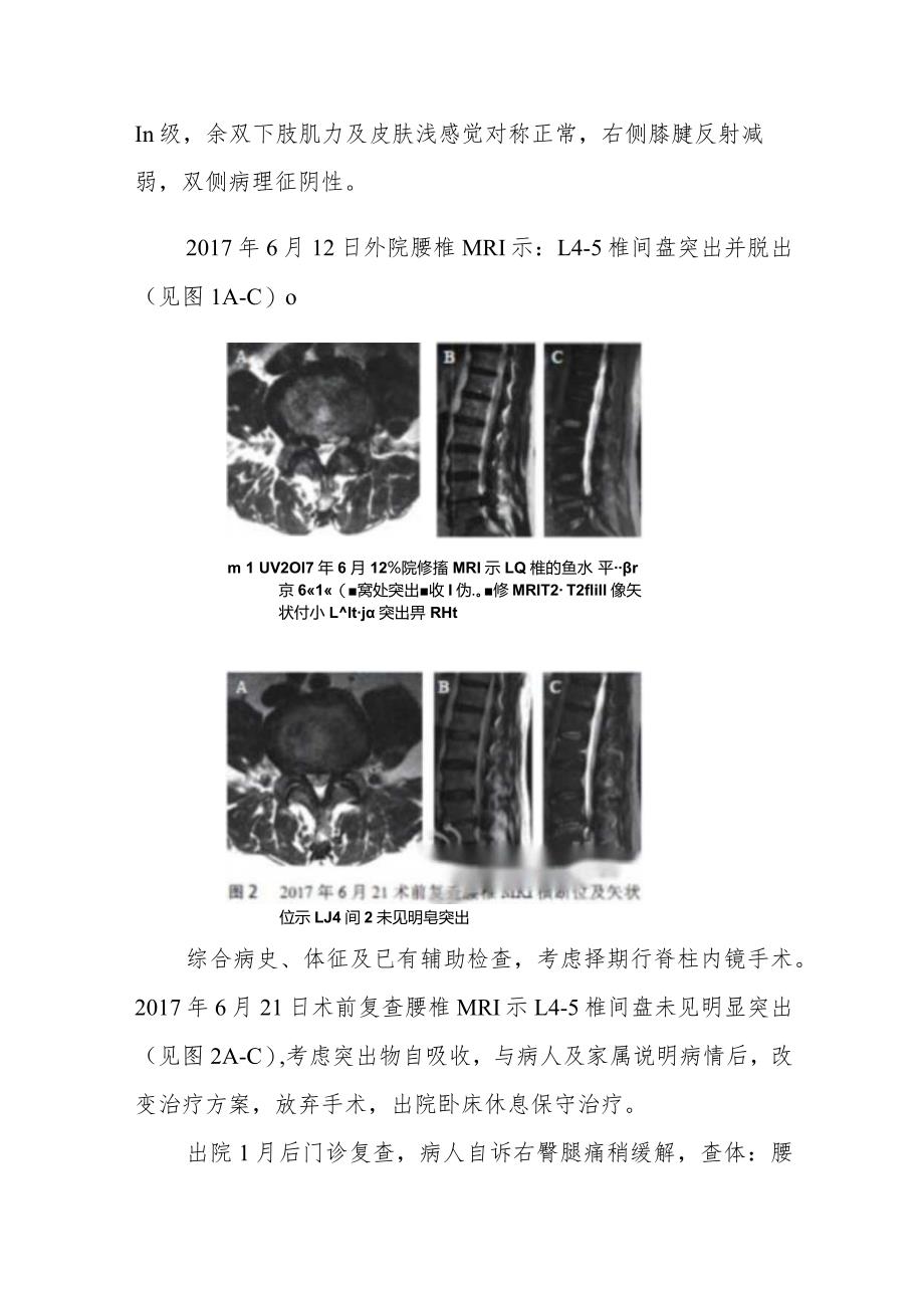 脊柱外科短时间腰椎间盘突出自吸收病例分析专题报告.docx_第2页