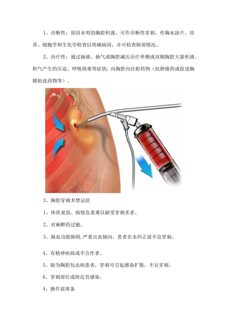 胸腔穿刺术临床技能操作.docx_第2页