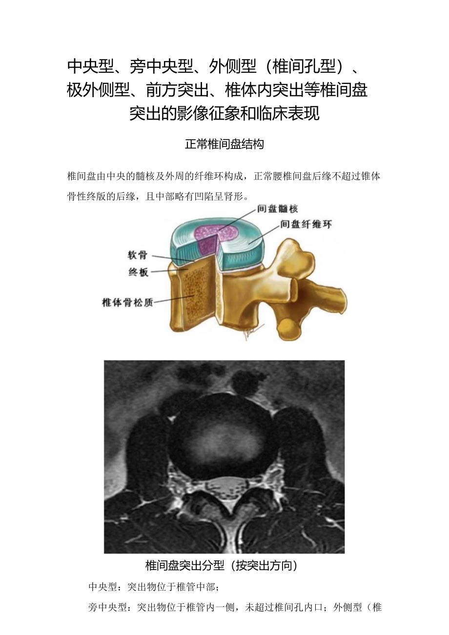 中央型、旁中央型、外侧型（椎间孔型）、极外侧型、前方突出、椎体内突出等椎间盘突出的影像征象和临床表现.docx_第1页