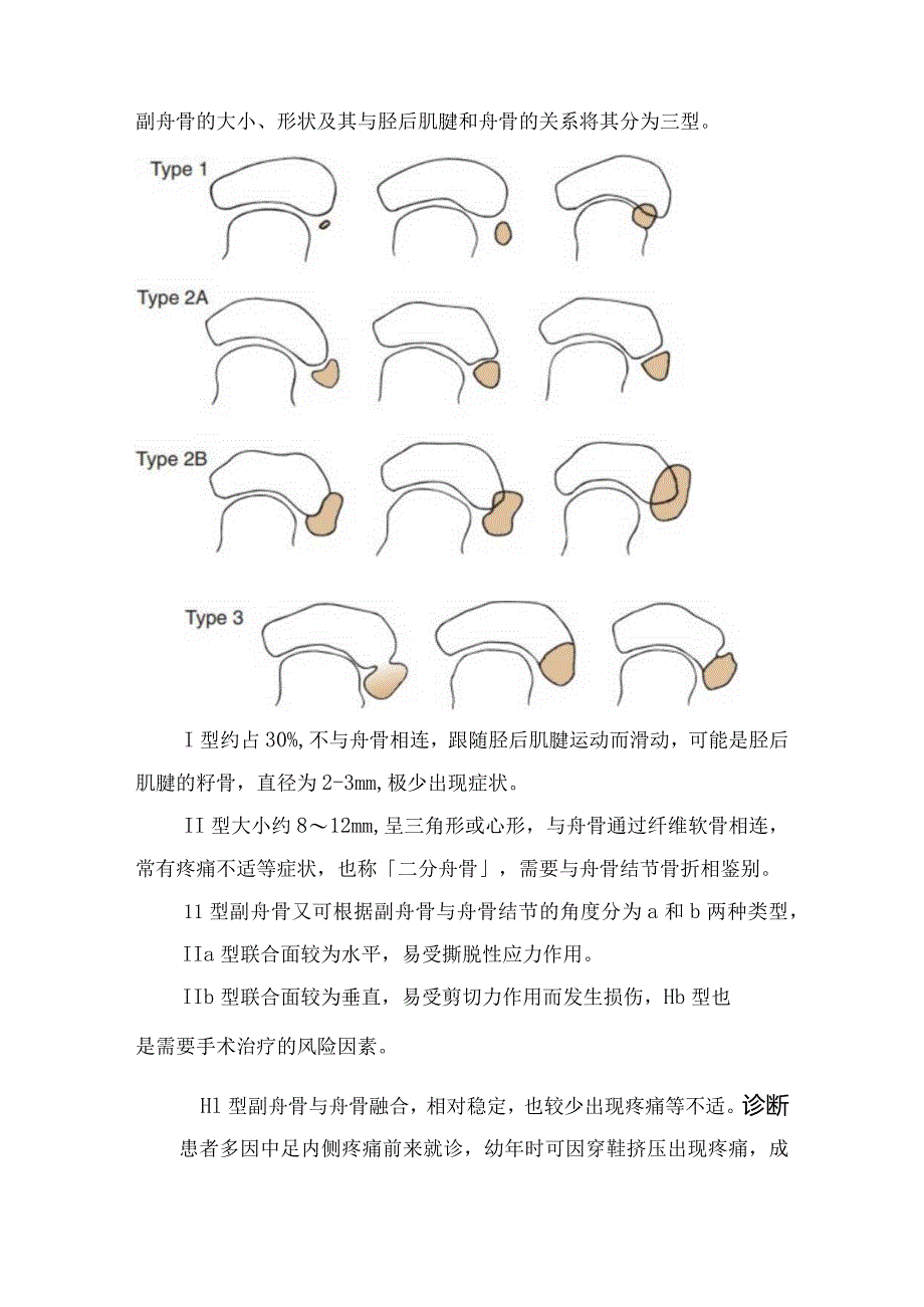 足副舟骨综合征病理、诊断、保守治疗及手术治疗.docx_第2页