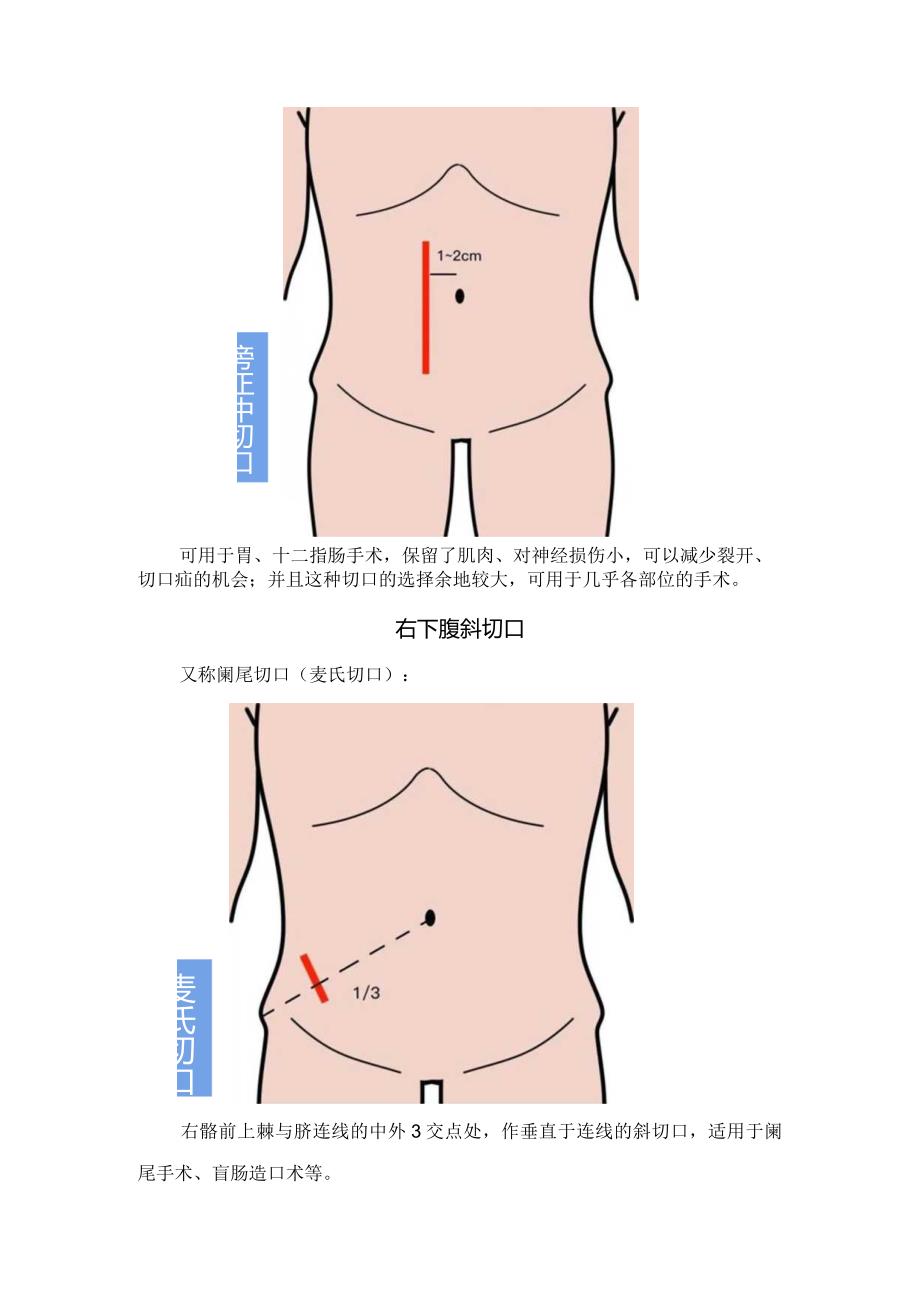 临床外科旁正中切口、右下腹斜切口、横切口、经腹直肌切口、胸腹联合切口等开腹手术常用切口要点.docx_第2页