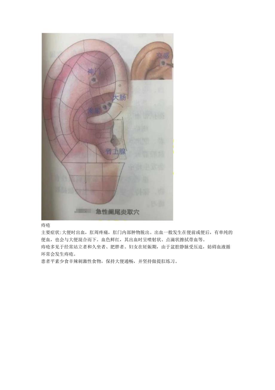 2.19耳穴 乳腺增生 阑尾炎 痔疮.docx_第3页