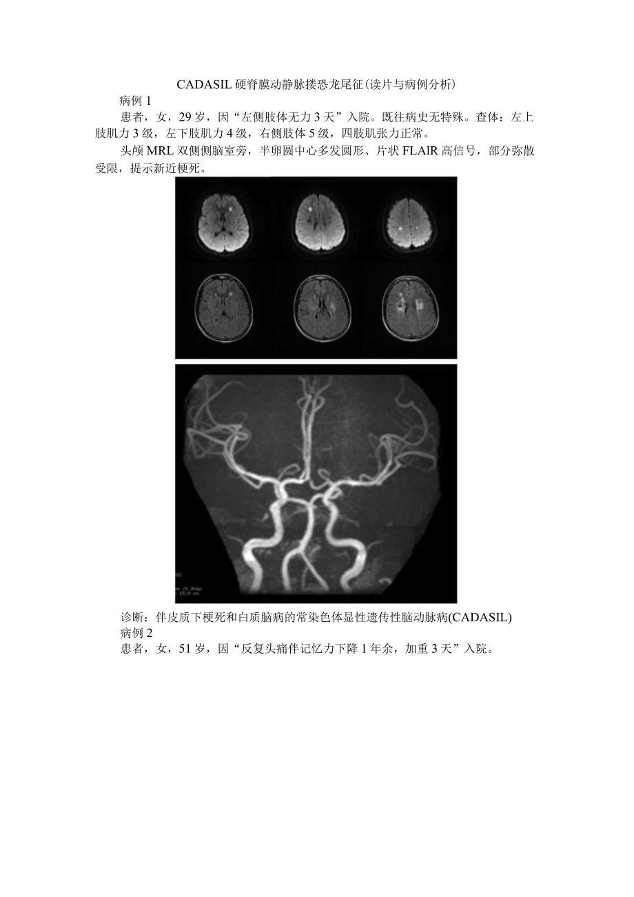 CADASIL 硬脊膜动静脉瘘 恐龙尾征(读片与病例分析).docx_第1页